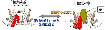内痔核U度